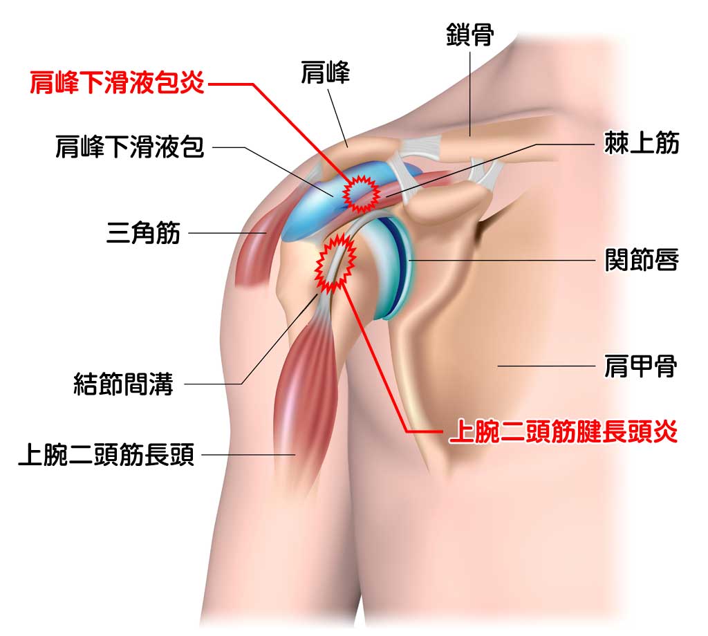 肩峰下滑液包炎