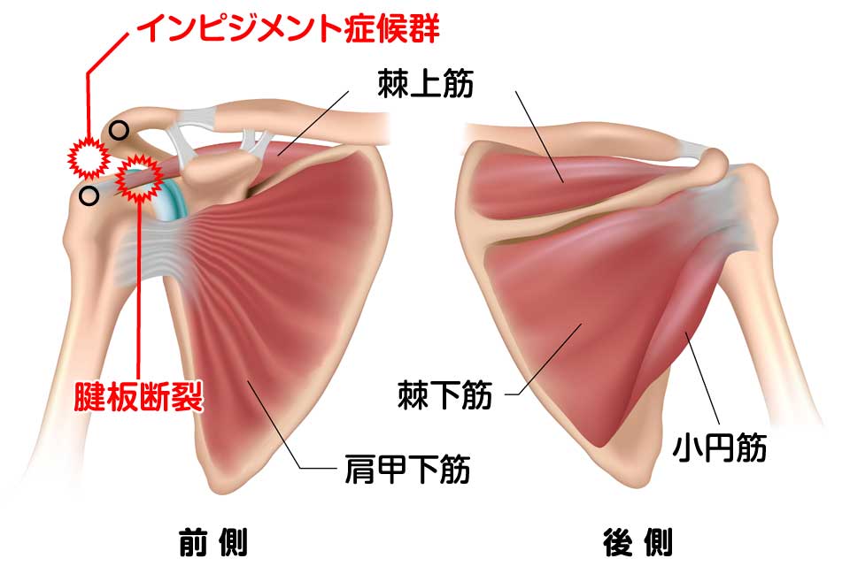 インピジメント症候群