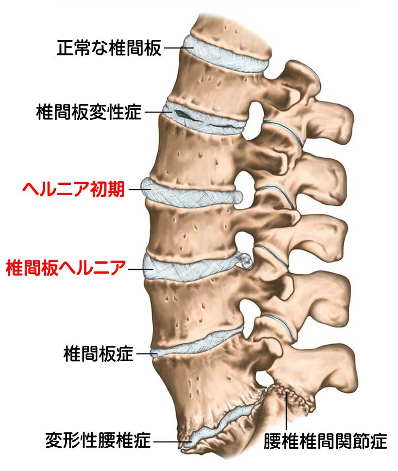 腰椎椎間板ヘルニア