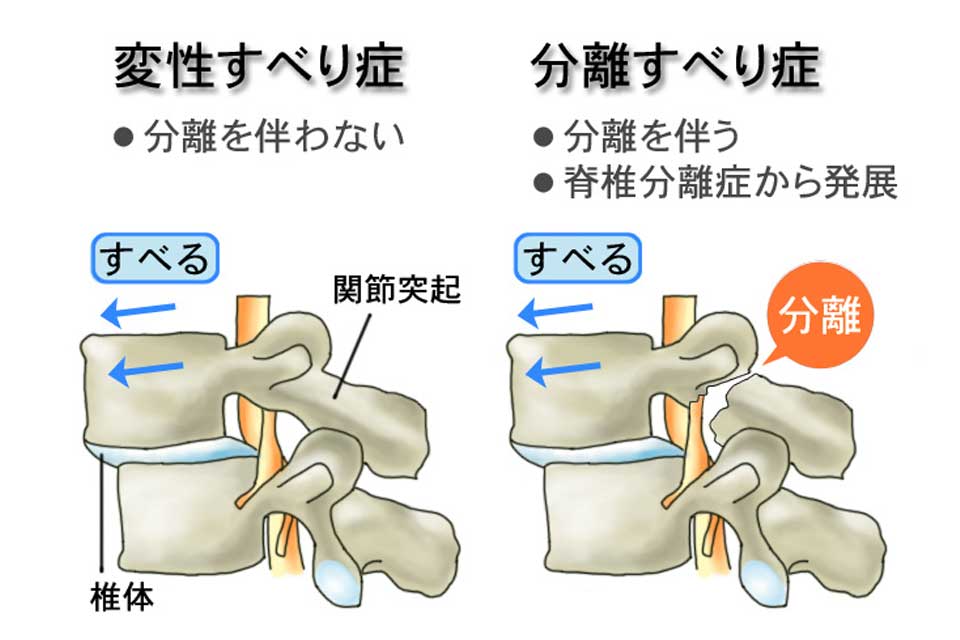 分離症（すべり症）