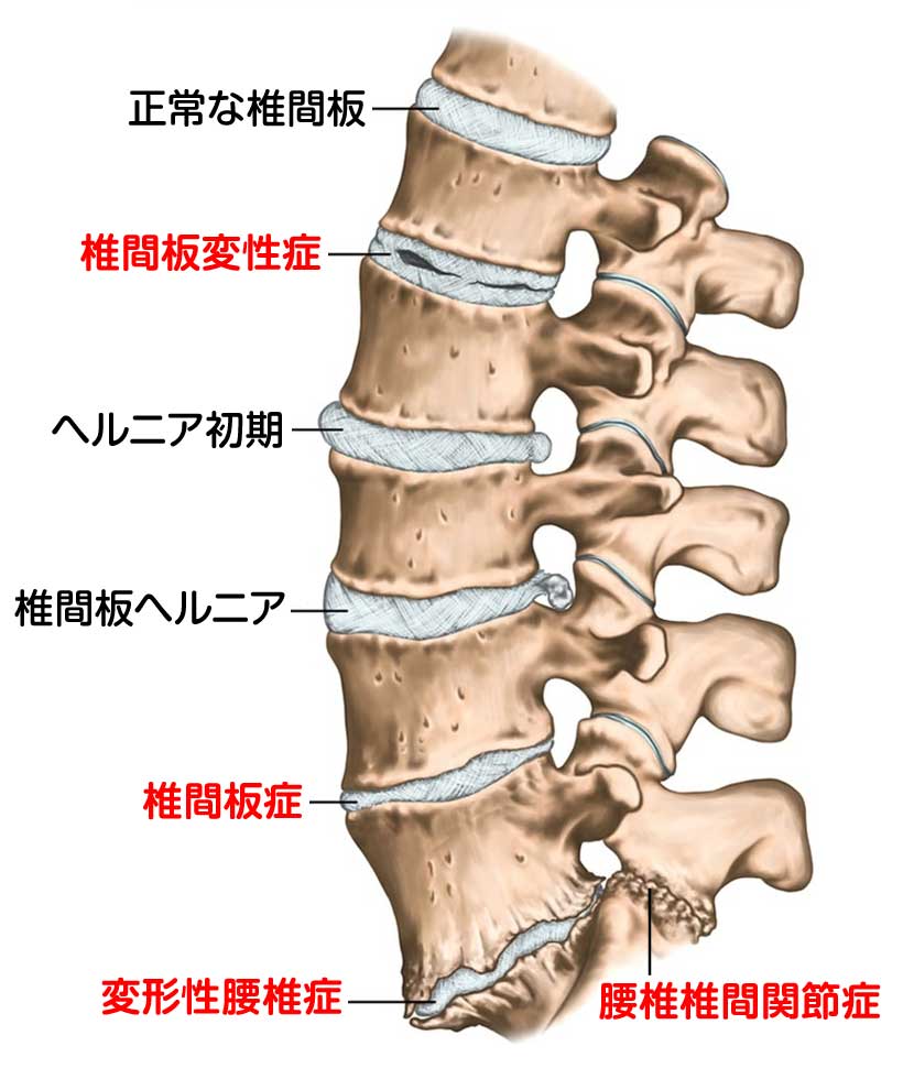 椎間板症